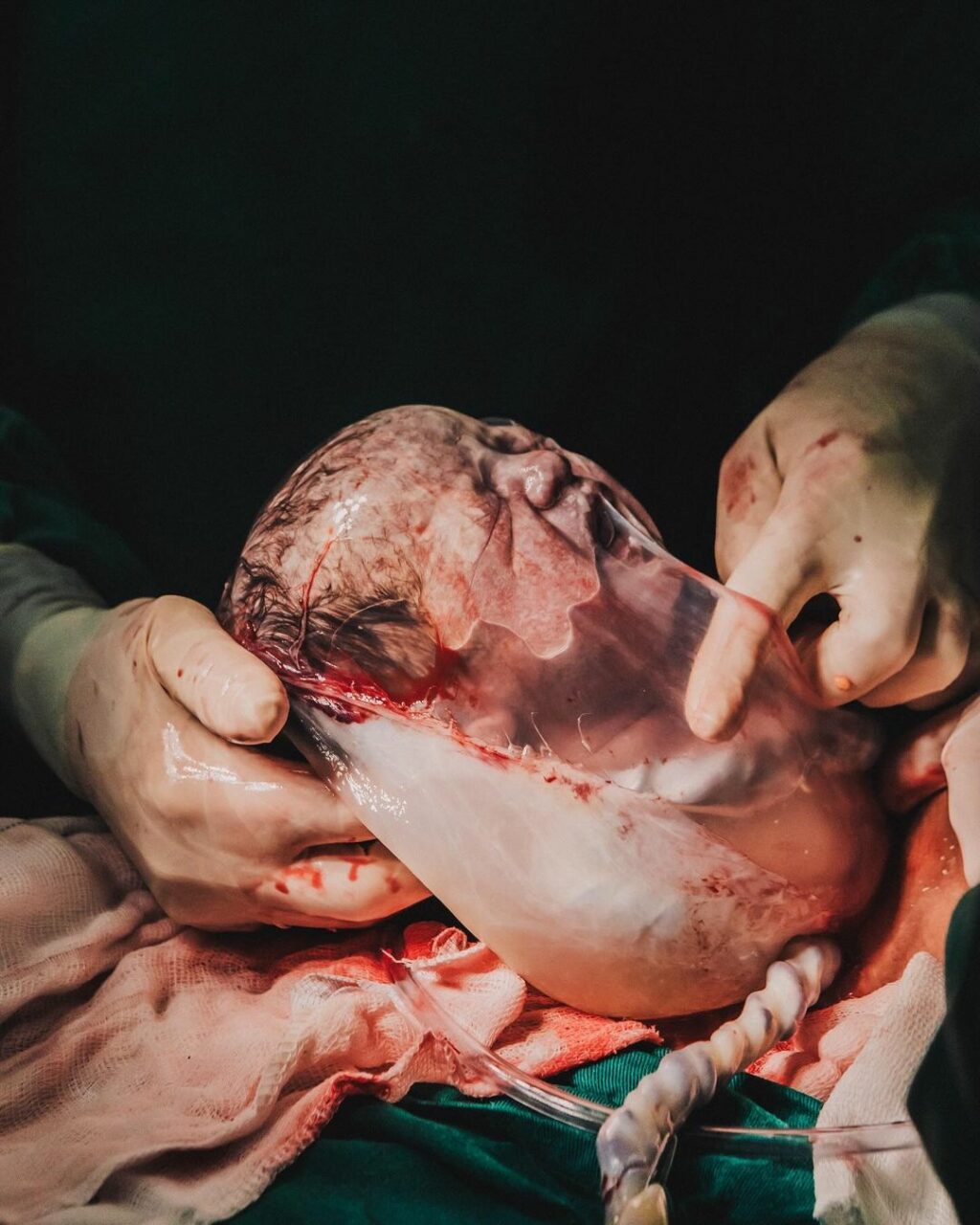 Fotógrafa registra momento emocionante de nascimento de bebê empelicada em Balneário Camboriú (5)