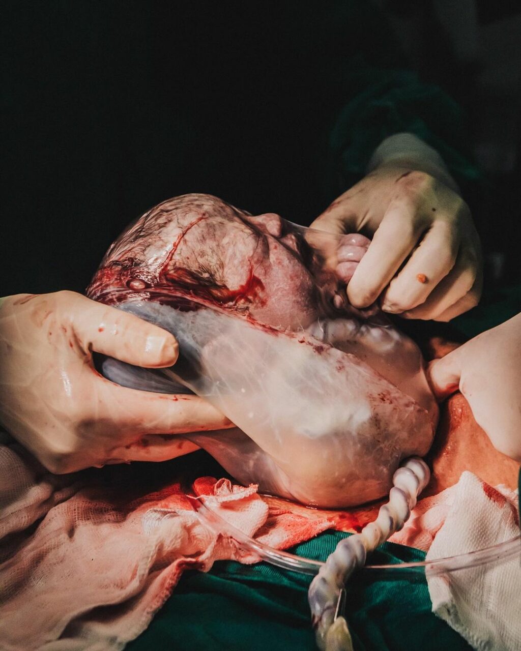 Fotógrafa registra momento emocionante de nascimento de bebê empelicada em Balneário Camboriú (5)