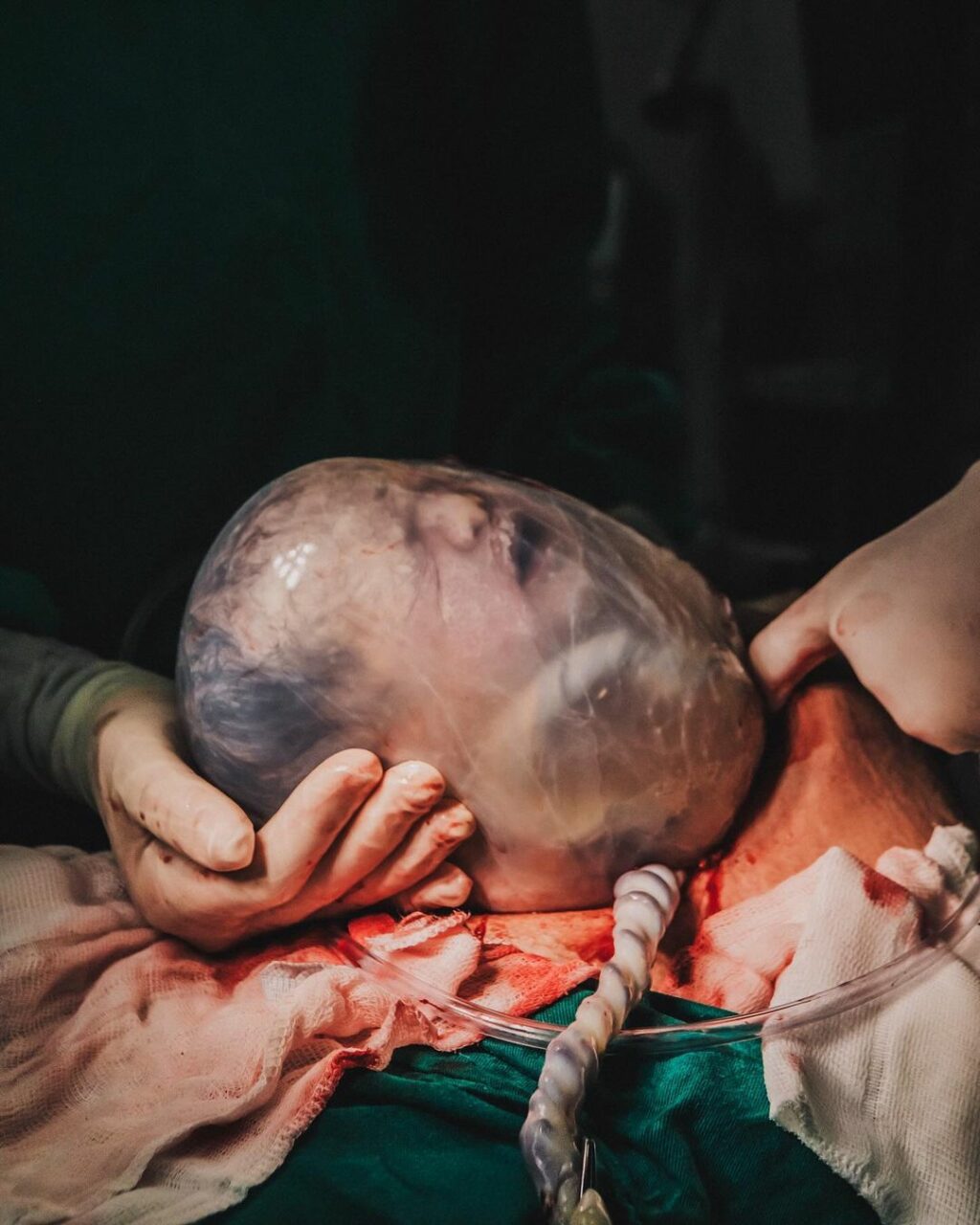 Fotógrafa registra momento emocionante de nascimento de bebê empelicada em Balneário Camboriú (5)