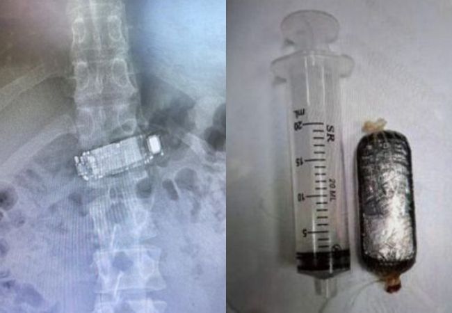 Detento engole celular e passa por cirurgia para retirar o aparelho em SC