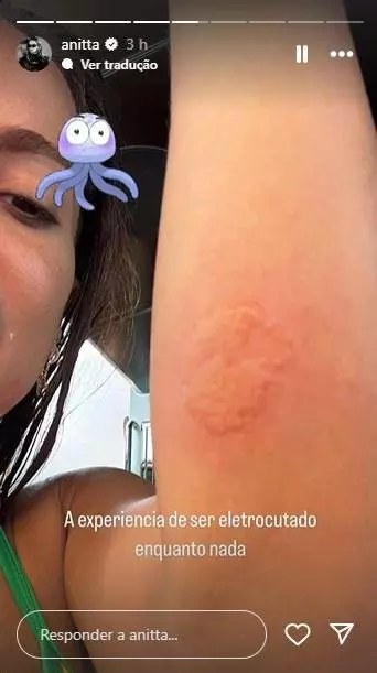 Anitta sofre queimadura durante mergulho